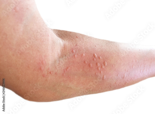 Skin rash in the forearm.
