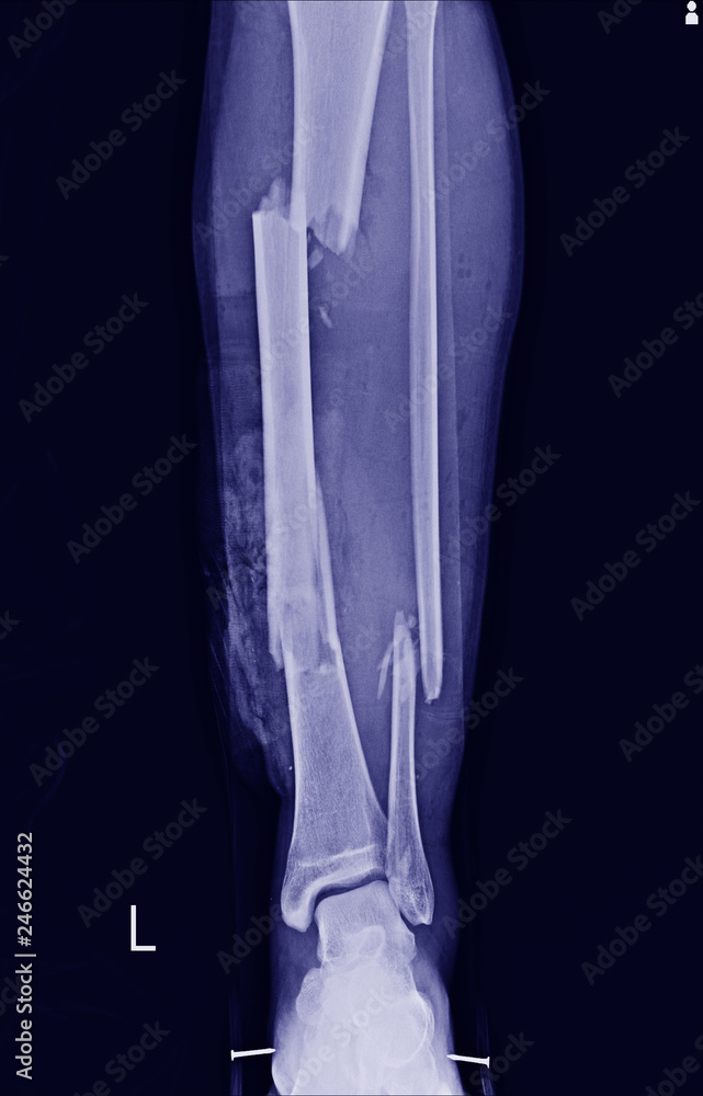 Multiple fracture leg tibia and fibular Multiple fracture leg tibia and fibular