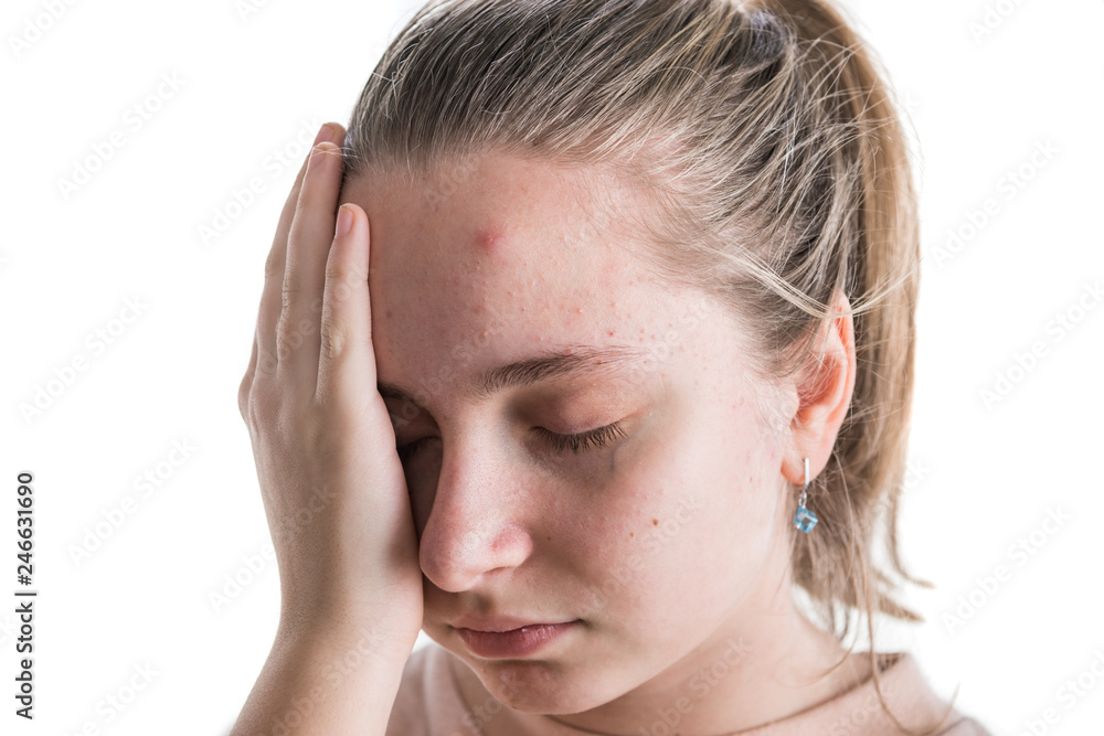 Upset teen girl with problematic skin posing on a white background. Upset teen girl with problematic skin posing on a white background.
