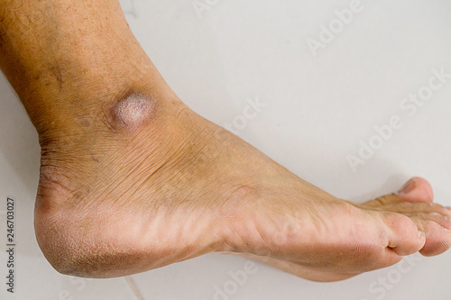 Closed-up of a dry and cracked heel, crack heel on white background