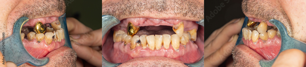 rotten teeth, caries and plaque close-up in an asocially ill patient. The concept of poor hygiene and health problems