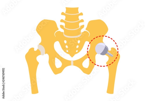 Hip replacement partly half. Vector illustration. Isolated on white background