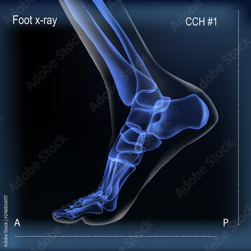 Medial view x ray of bones the of foot.