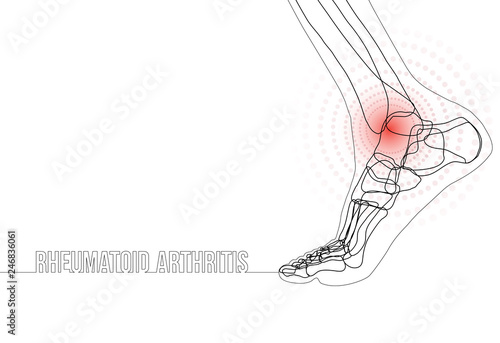 Continuous line drawing concept banner about Rheumatoid arthritis
