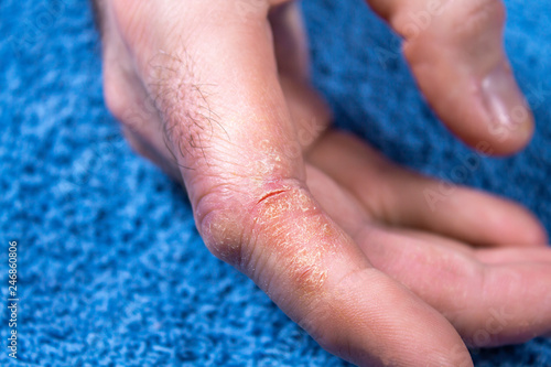 Twardy, zrogowaciały i popękany naskórek na palcu w męskiej dłoni. Łuszczyca, uczulenie, alergia, photo
