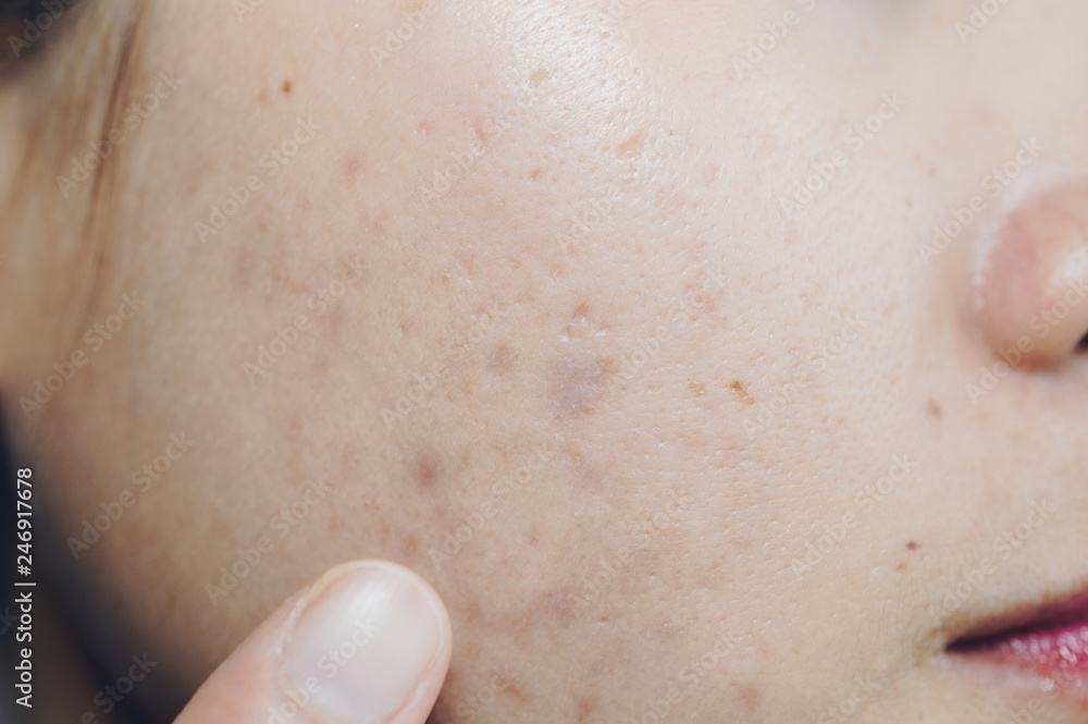 Close up of Asian woman face has problems with skin on her face. Problems with acne and scar on the female skin. Close up of Asian woman face has problems with skin on her face. Problems with acne and scar on the female skin.