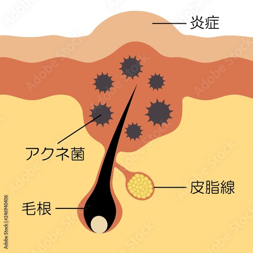 アクネ菌とニキビの図 photo