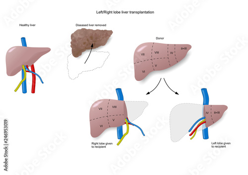Billede på lærred liver transplantation (left or right lobe9