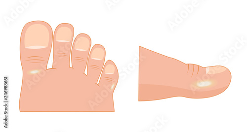 callus on foot vector