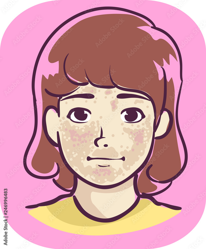 Kid Girl Symptom Brown Patches Illustration