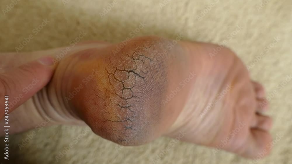 human heel crack, foot health problems, neglected heel of a human, cracked heels human foot, human heel crack, foot health problems, neglected heel of a human, cracked heels human foot,