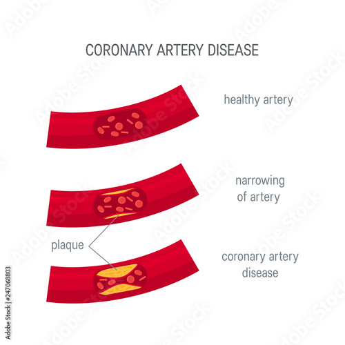 Coronary artery disease concept in flat style