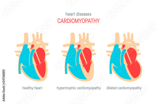 Heart disease vector concept in flat style