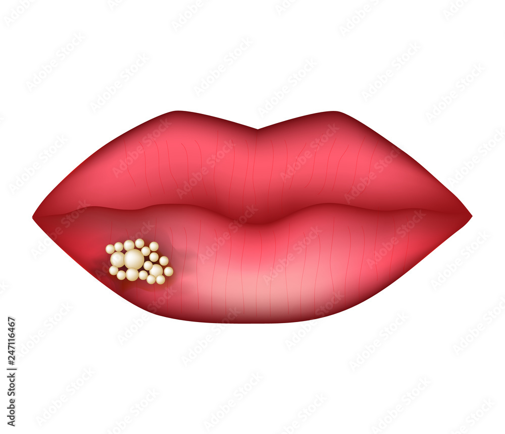 Herpes on the lip. Infographics. Vector illustration on isolated background. Herpes on the lip. Infographics. Vector illustration on isolated background.