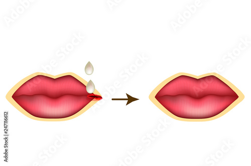 Treatment crack lips. A drop of medication. Infographics. Vector illustration on isolated background.