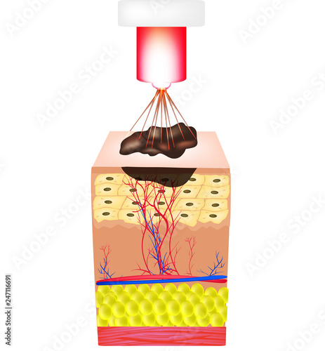 Removal of birthmarks, popiloma, wart laser. The structure of moles on the skin. Infographics. Vector illustration on isolated background.