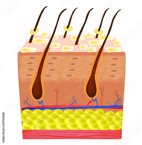 Seborrhea skin and hair. Dandruff seborrheic dermatitis. Dysfunction of the sebaceous glands. Inflammatory skin disease. Anatomical structure. Infographics. Vector illustration on isolated background.