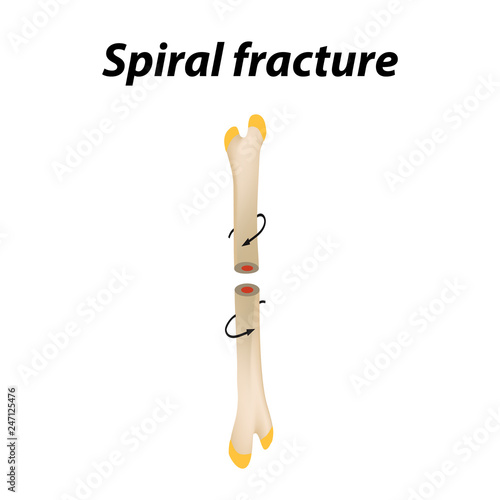 Spiral Bone Fracture. Infographics. Vector illustration on a lined background.