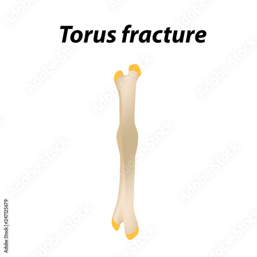Torus fracture Bone. Infographics. Vector illustration on a lined background.
