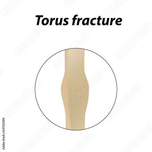 Torus fracture Bone. Infographics. Vector illustration on a lined background.