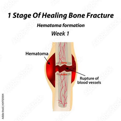 1 Stage Of Healing Bone Fracture. Formation of callus. The bone fracture. Infographics. Vector illustration on isolated background.