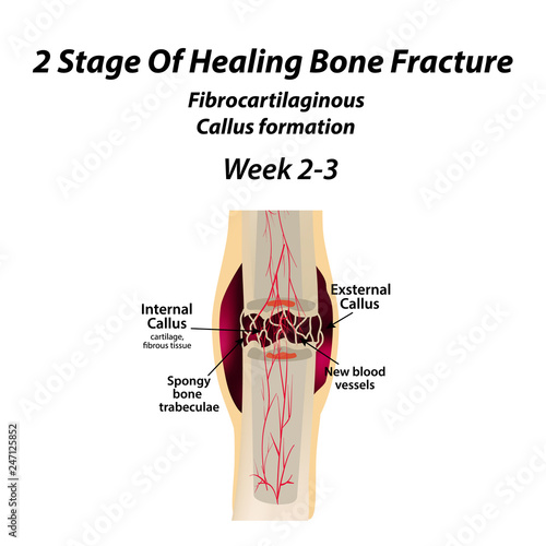 2 Stage Of Healing Bone Fracture. Formation of callus. The bone fracture. Infographics. Vector illustration on isolated background.