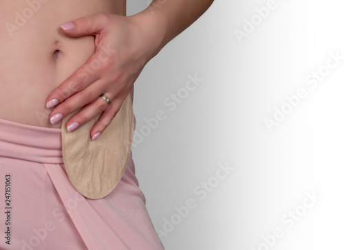 Wallpaper Mural colostomy pouch attached to patient - image Torontodigital.ca