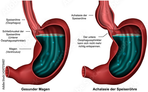 Achalasie der Speiseröhre, Illustration photo