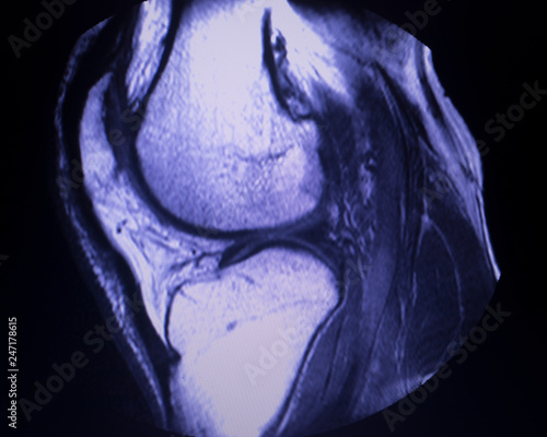 Canvas Print MRI knee meniscus tear scan