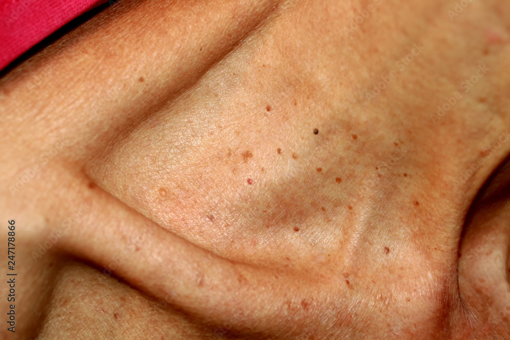 Fototapeta premium Neck and collarbone in papillomas. Papilloma on the skin.