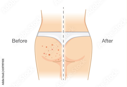 Buttocks with many pimples and after skin treatment. Illustration about health care.