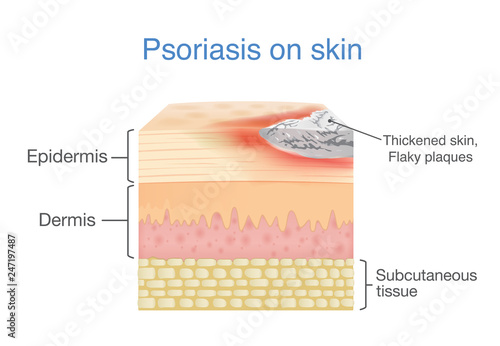 Illustration of human skin layer when plaque psoriasis signs and symptoms appear.