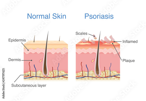 Normal skin layer and skin when plaque psoriasis signs and symptoms appear. illustration about dermatology diagram. photo