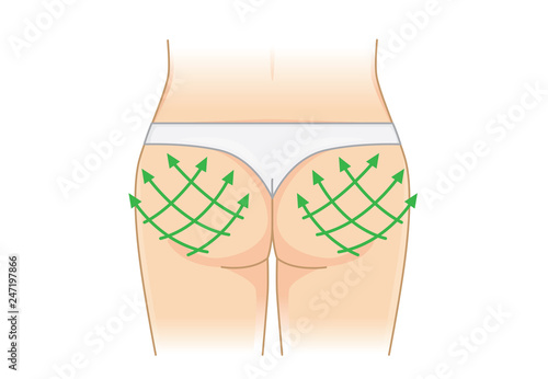 Illustration about tightening up on the Hip. Lifting skin and muscle for firming and beauty.