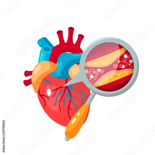 Coronary artery disease concept in flat style