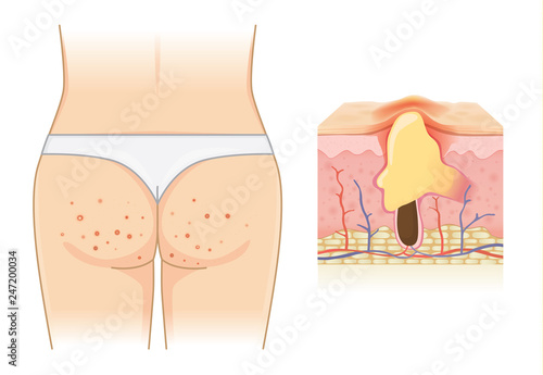 Pimples on buttocks and skin layer with acne isolated on white. Illustration about Dermatology.