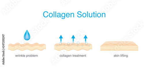 Collagen Treatment wrinkle on Skin to be smoother and younger. Illustration about beauty and medical.
