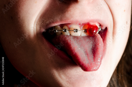 Pomegranate seed in the teeth braces