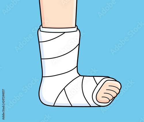Orthopedic plaster or fiberglass cast, broken leg, bone fracture, vector illustration.