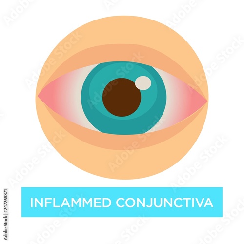 Inflamed conjunctiva conjuntivitis sore eye medicine and health