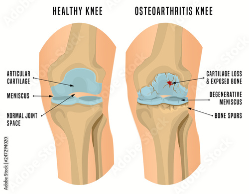 Osteoarthritis Knee Poster