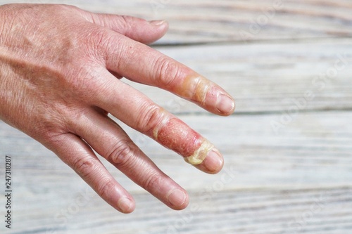 woman with a burn of the skin and fingers, injuries with boiling water, an accident at home, careless behavior with boiling water, steam, scales on the skin, an injured hand, injured fingers of a