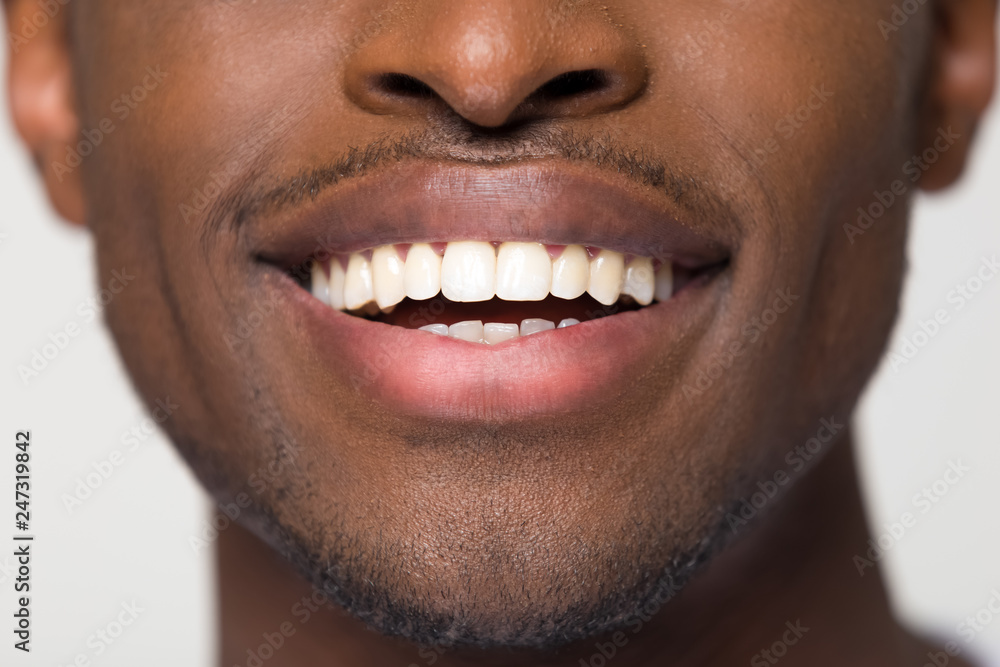Foto de Close up view of beaming orthodontic white wide male smile