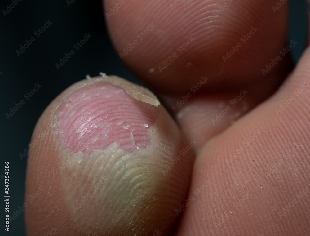 Shoe bite wounds Shoe bite wounds