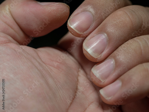 Wallpaper Mural Shoe bite wounds Torontodigital.ca