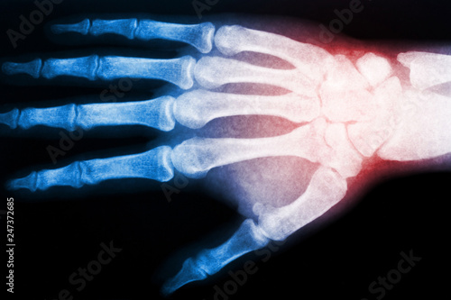 X ray scan of hand. Red color as indicator of pain spot. Skeleton fingers and wrist image. Healthcare and medical background.