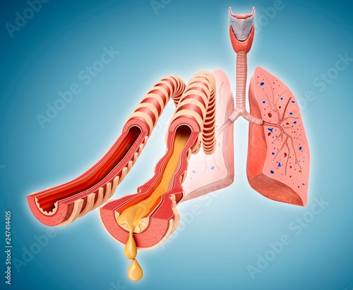 Normal and infected lung bronchi, illustration
