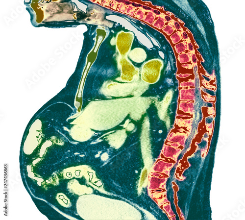Spine in ankylosing spondylitis, X-ray photo