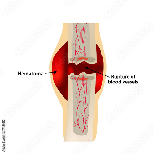 1 Stage Of Healing Bone Fracture. Formation of callus. Hematoma. The bone fracture. Infographics. Vector illustration on isolated background.