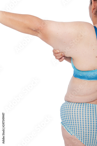 Middle aged woman with sagging excess arm skin after extreme weight loss. Before brachioplasty, panniculectomy, abdominoplasty and mummy makeover. Back view part left arm holding excess skin.